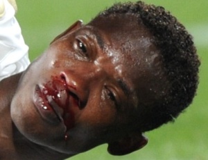 John Paintsil, de Gana, sangrou muito aps se chocar com o seu companheiro de equipe no fim